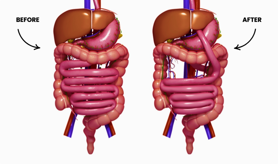 Gastric Bypass